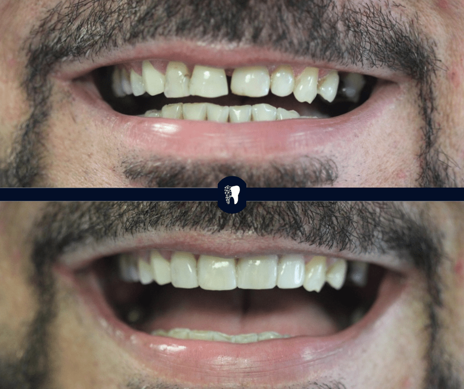 Before and after — smile transformation case 1