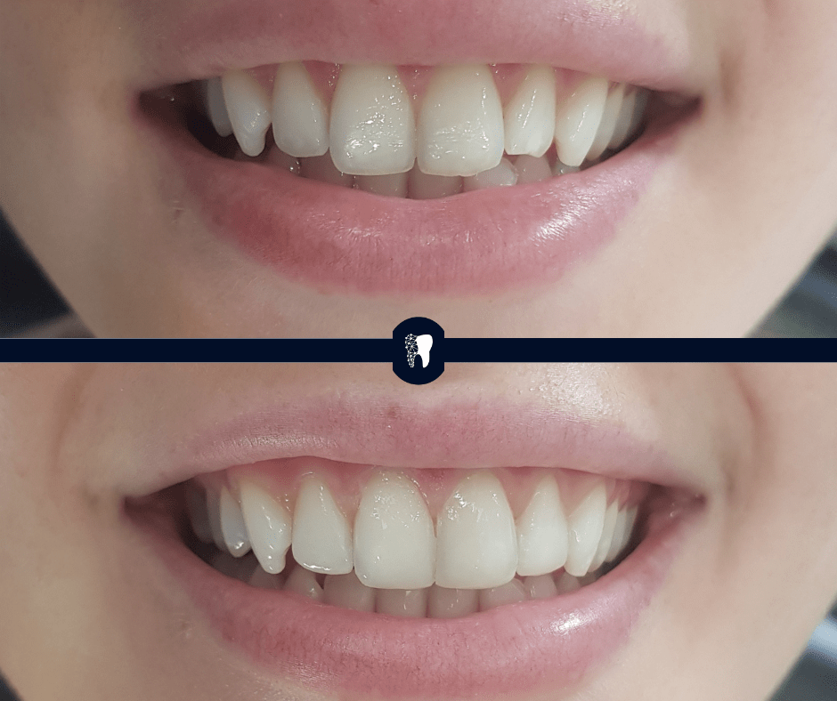 Before and after — smile transformation case 10