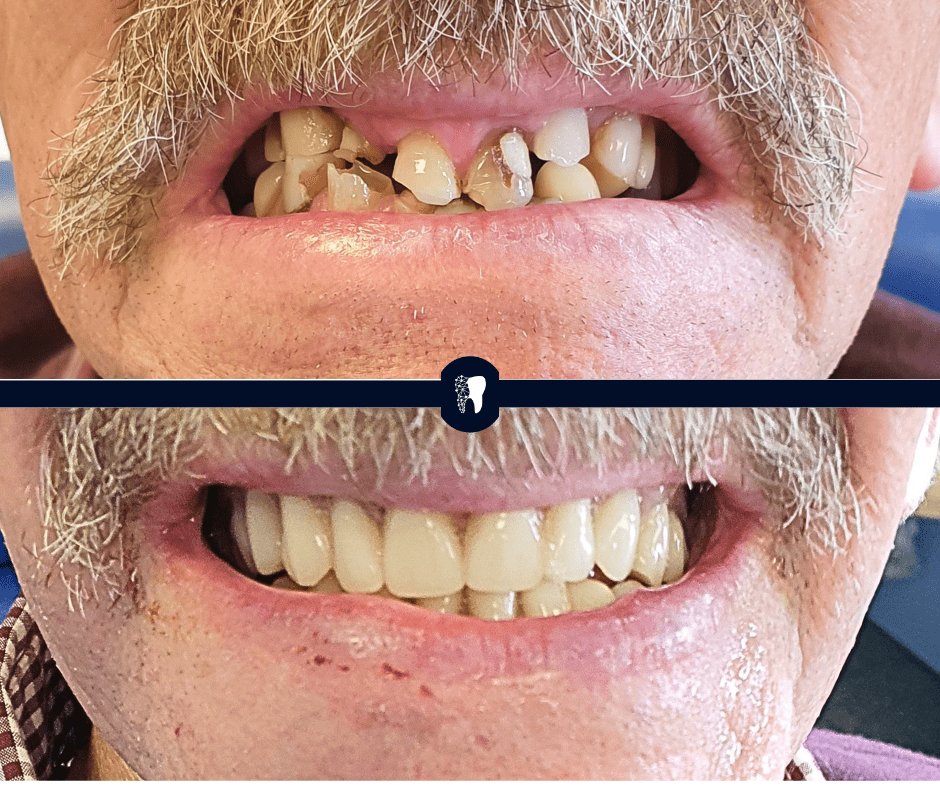 Before and after — smile transformation case 13