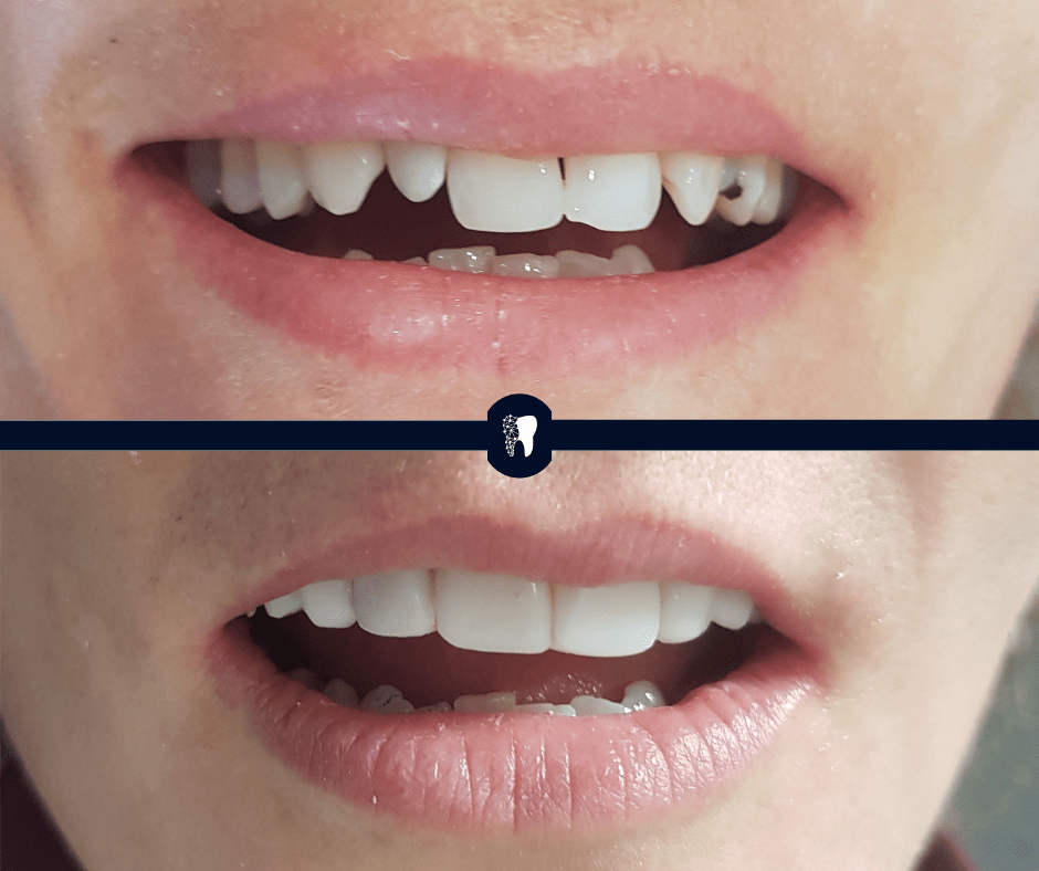 Before and after — smile transformation case 6