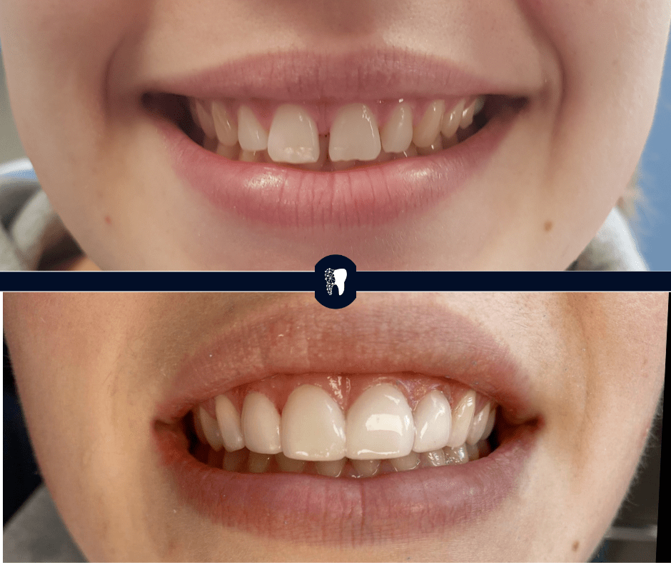 Before and after — smile transformation case 8